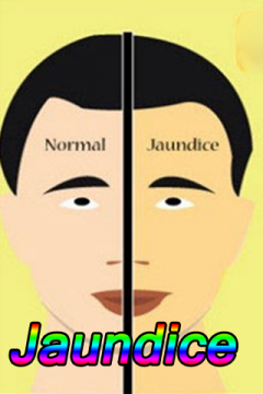 Jaundice Disease